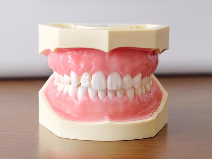 磁力式義歯